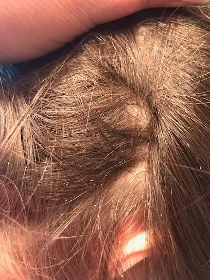 Lice Free Noggins Staten Island Natural Lice Removal Treatment - lice treatment clinic in Service Area, NJ