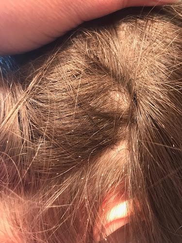 Lice Free Noggins Easton - Natural Lice Removal Treatment - lice treatment clinic in Easton, PA